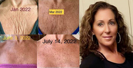 Before and after skin