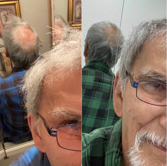 Before and after hair growth