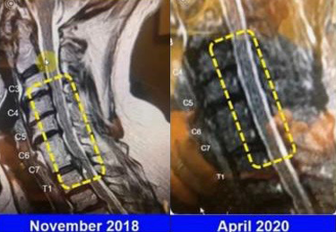 Before and after nerve supply