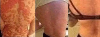 Before and after skin