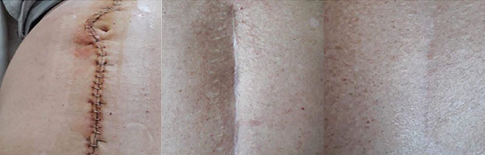 Before and after scar